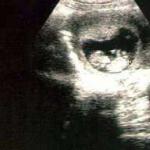 Minggu kesebelas kehamilan - apa yang terjadi pada bayi, foto janin, sensasi